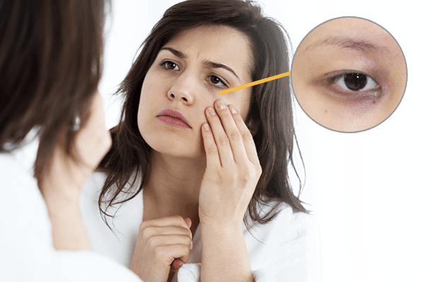 how to get rid of dark circles under the eyes