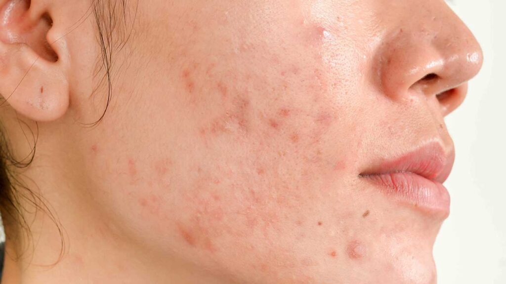how to remove pimple spots naturally at home