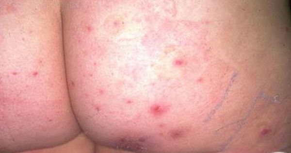 Folliculitis Butt Acne - Types of butt acne 