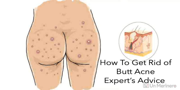 How to get rid of butt acne