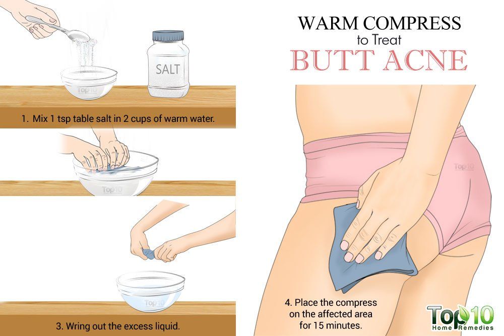 Warm Compress To treat Butt Acne - How to treat butt acne