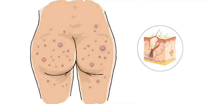 What is Butt acne - Treatment of butt acne