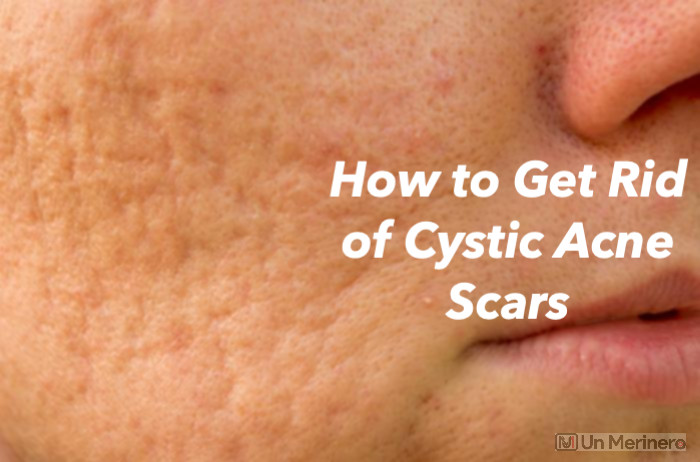 How to get rid of cystic acne Scars