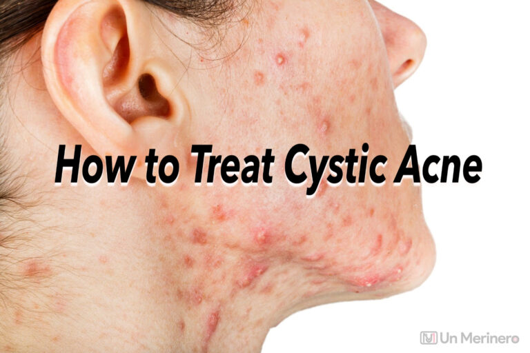 How to treat cystic acne - how to treat cystic acne at home - treatment of cystic acne