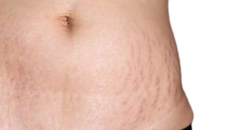 How to Get Rid of Stretch Marks Forever